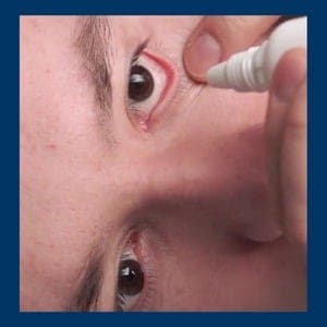 הזלפת טיפות עיניים לאחר ניתוח קטרקט - שלב 2