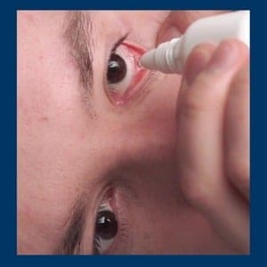 הזלפת טיפות עיניים לאחר ניתוח קטרקט - שלב 3